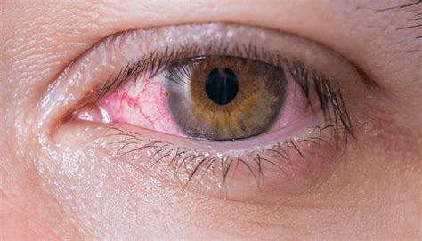 what you should know about eye allergies top sites health