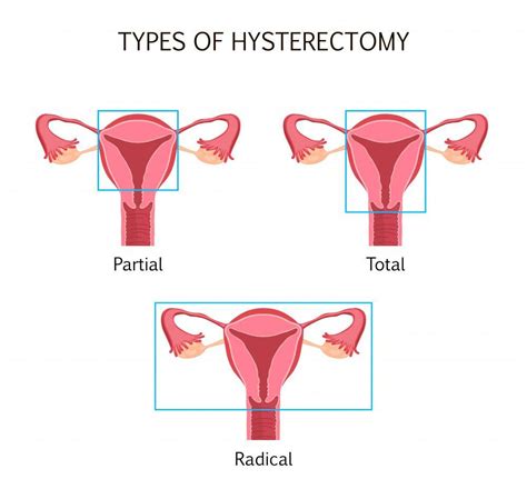 What Happens To Your Body After A Hysterectomy John Macey Md Ob Gyn