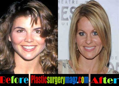 Lori Loughlin Plastic Surgery Before And After Plastic