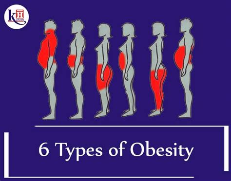 6 types of obesity and solutions to overcome each