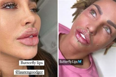Why Butterfly Lip Filler Is Not A Good Idea Simply Clinics