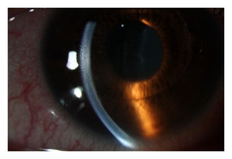 Toxic Anterior Segment Syndrome Tass In The Right Eye
