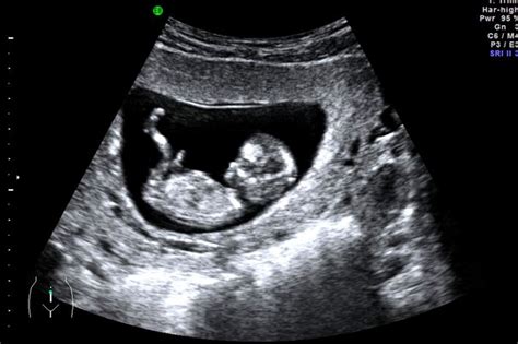 the pregnancy dating scan nhs uk