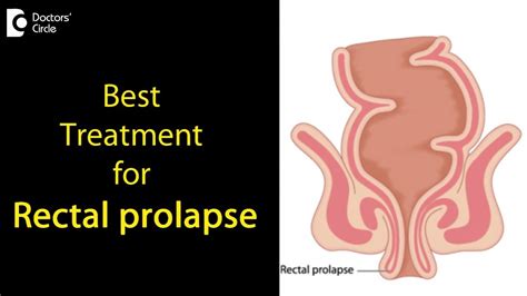 What Is A Rectal Prolapse How Is It Treated Dr Rajasekhar M R