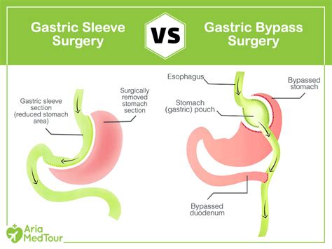 Gastric Bypass Vs Gastric Sleeve A Close Comparison