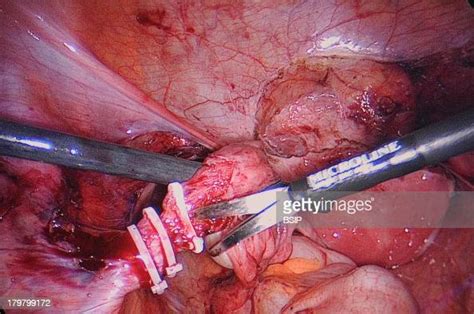 Hystero Ovariectomy Pictures Getty Images