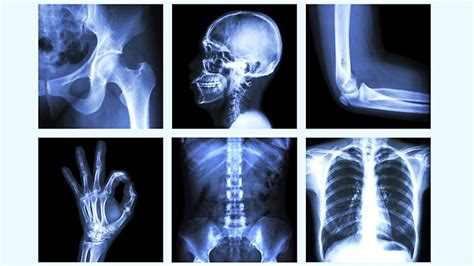 10 Things Your Doctor Won T Tell You About Your Bones And Osteoporosis