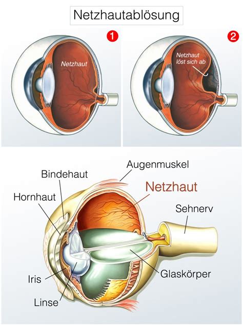 netzhautabloesung ablatio retinae symptome und verlauf