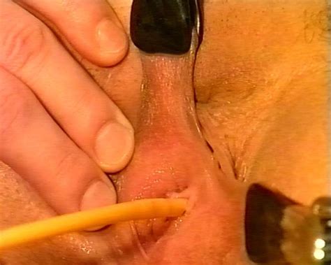 filling bladder with catheter mega porn pics