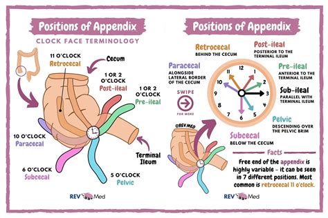 appendix positions retrocecal  common grepmed