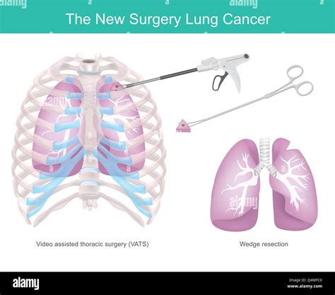 surgical technique  lung cancer surgical technique removing