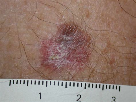 sintomas  signos del melanoma medicina basica