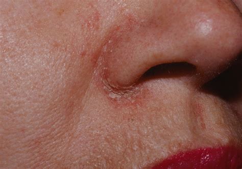 seborrheic dermatitis  nose pictures