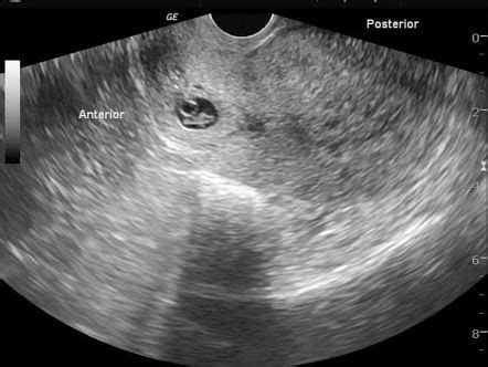 caesarean scar ectopic pregnancy radiology reference article