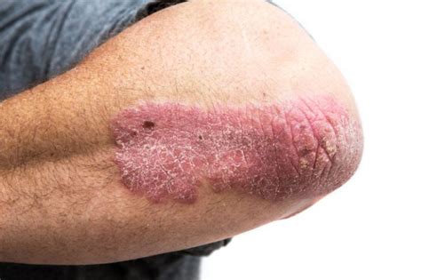 Genital Rash Common Causes Pictures And Treatments