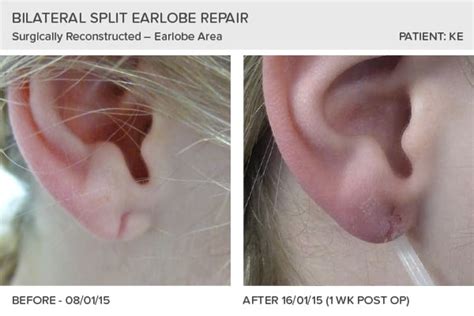 earlobe reconstruction testimonials skin surgery clinic leeds