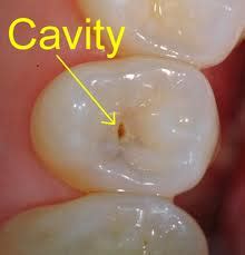 tooth cavity removal