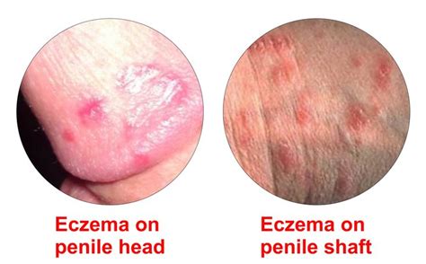 eczema dry skin symptoms causes scabs on the penis men s health pinterest the o jays and