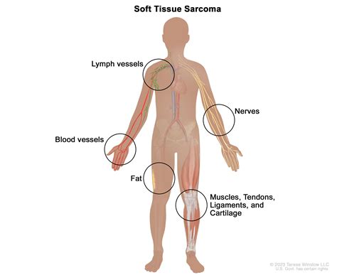 Soft Tissue Sarcoma Vanderbilt Ingram Cancer Center