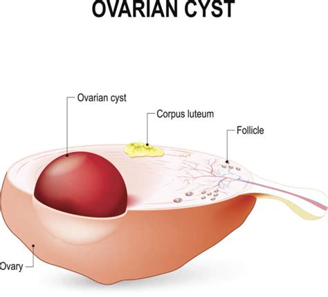 the 6 types of ovarian cysts functional cysts