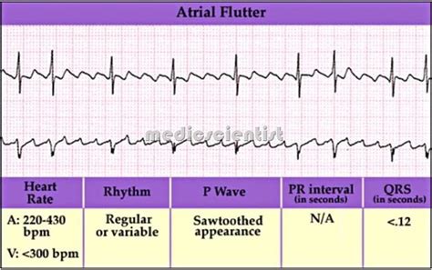 Atrial Flutter Causes Atrial Flutter Symptoms Causes Diagnosis With