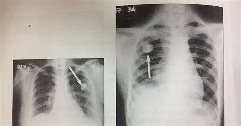 xrays  solitary nodule   lung