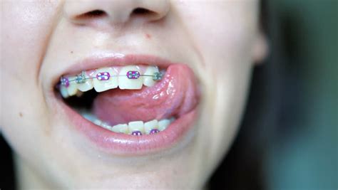 Taking Care Of Your Tongue With Braces Hutta And Hutta