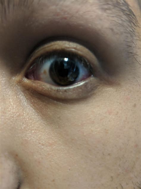 noticed brown spot   eye making    nervous