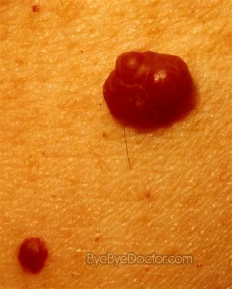 cherry angioma pictures causes removal treatment
