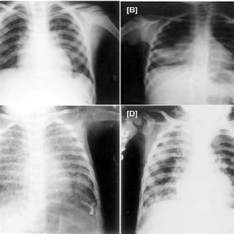 Fig S1 A Shows Chest Radiograph Reveals Bilateral Hilar Adenopathy