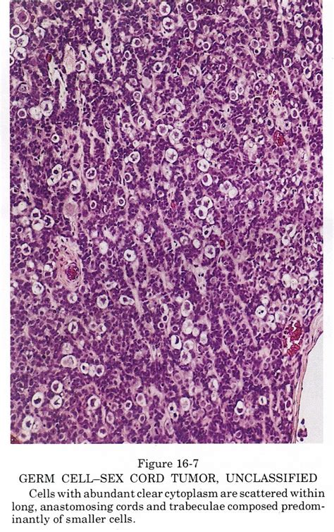 Pathology Outlines Unclassified Sex Cord Stromal Tumors