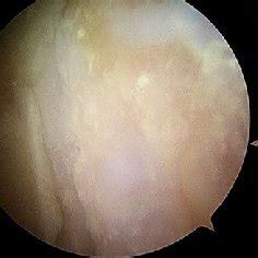 normal healthy cartilage  discrete cartilage defect  full