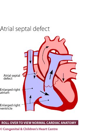 atrial septal defect congenital childrens heart centre