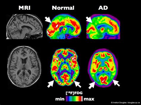 pet scan   healthy brain compared   brain   ear flickr