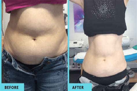 body contouring melbourne fat freezing melbourne cryolipolysis melbourne