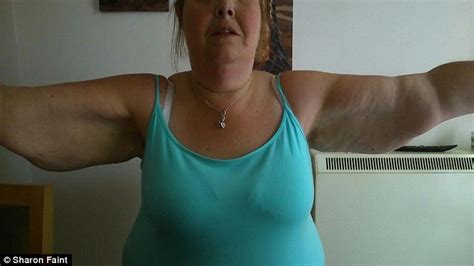 Morbidly Obese Woman Who Lost 18 Stone Reveals Her Saggy Skin Daily