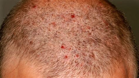 big small red itchy bumps   scalp american celiac