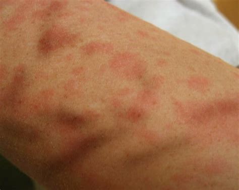 symptom itchy skin rashes images   finder
