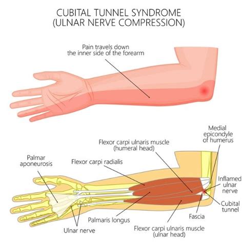 Cubital Tunnel Syndrome Ulnar Nerve Compression South