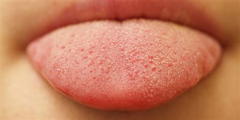 oral thrush  bumps   tongue   telling  huffpost