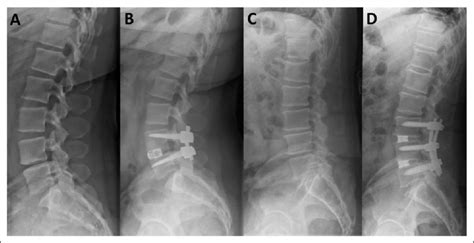 Standing Neutral Lumbar Radiographs Of Patients Who Underwent Open And