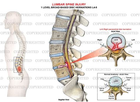 level   lumbar spine  paracentral disc herniation medical art works