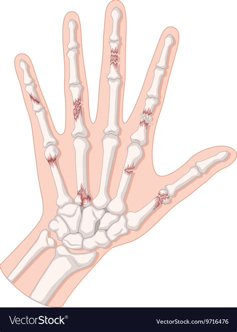 human hand bone diagram diagram media