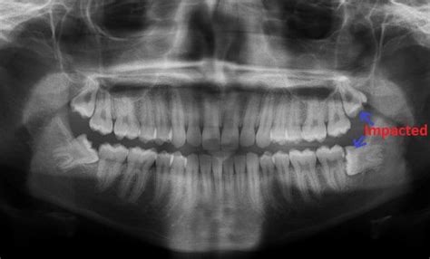 impacted tooth sign symptoms treatments know in details