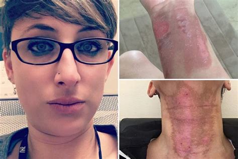 Woman Suffers Horrific Burns After Using A Sun Bed While Covered In