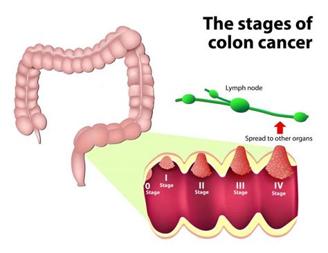 Stage 4 Colon Cancer Survival Rates Cancerwalls