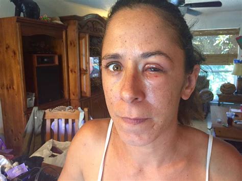 woman whose was eye glued shut gets medical treatment