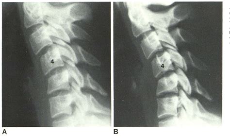 [pdf] anterior subluxation of the cervical spine hyperflexion sprain