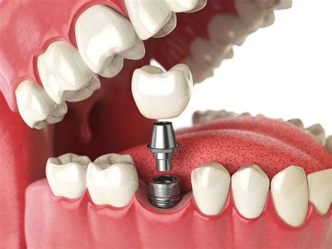 difference  implant supported crown  abutment crown