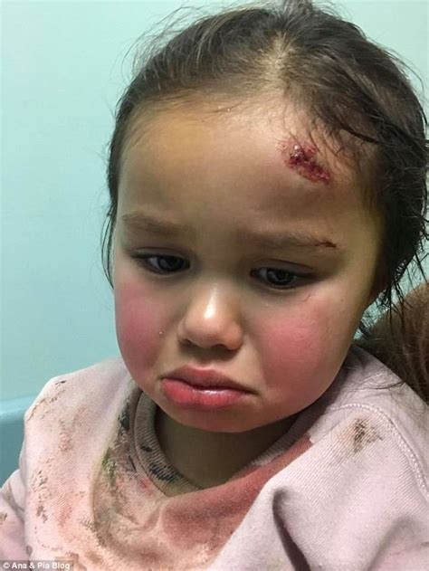 mother shares pictures of hole in her daughter s head daily mail online